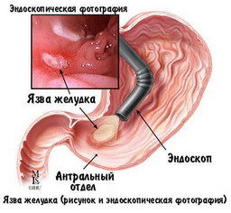 Эзофагогастродуоденоскопия